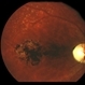 Central atrophic pigment changes